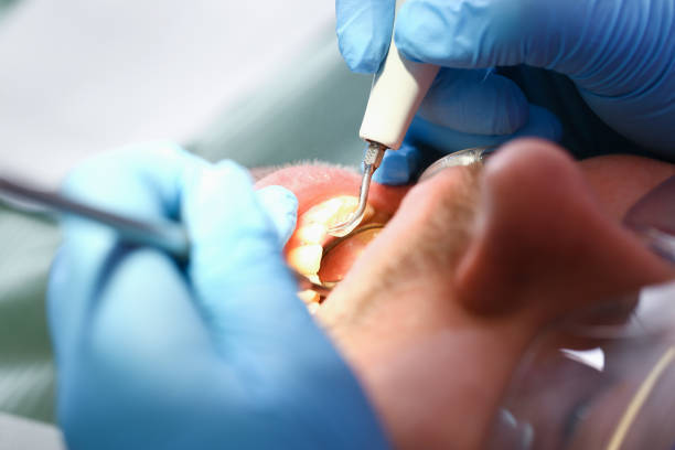 Best Emergency Wisdom Teeth Removal in Mendenhall, MS