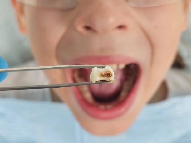 Best Emergency Treatment for Toothache in Mendenhall, MS